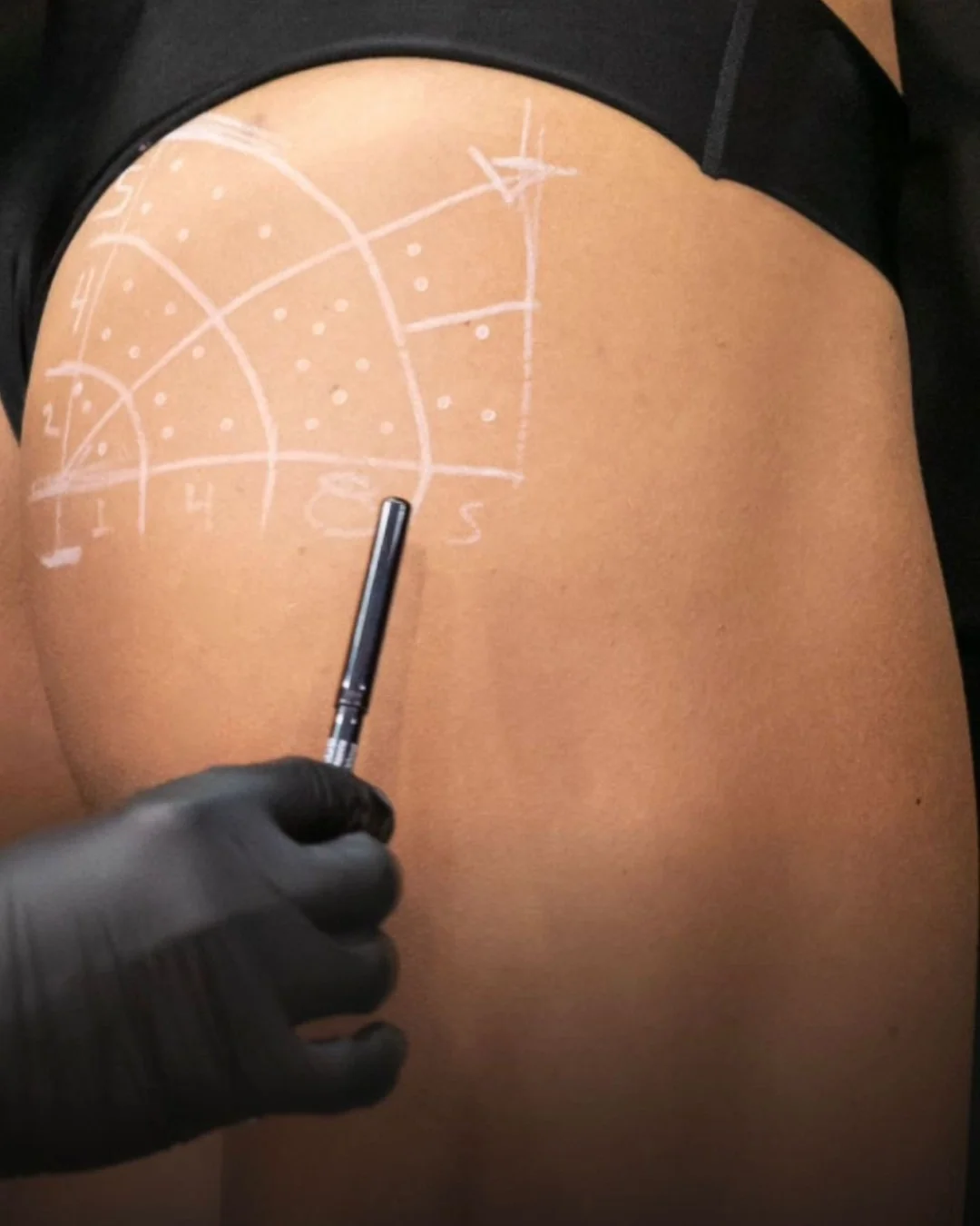 Tratamento Escultura e Contorno Corporal em Uberlândia - Tratamentos médicos para definição, firmeza e qualidade da pele: abdômen, glúteos, braços e peitoral